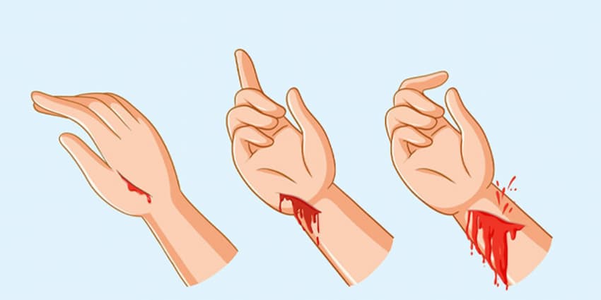 Types of external bleeding