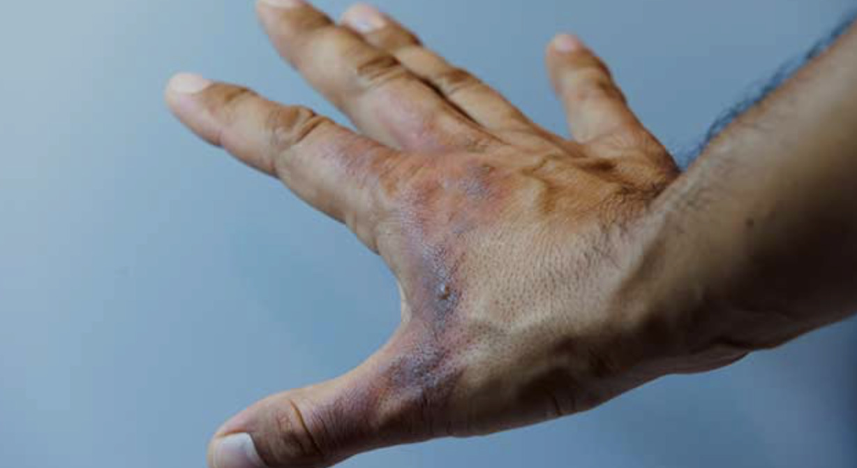 Types of burns