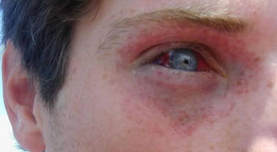 What is a barotrauma?