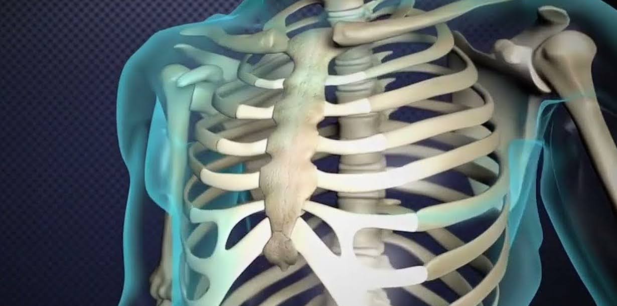What is a chest contusion?