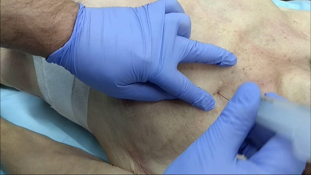 Implementation of pleural needle decompression