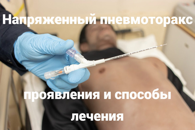 Напряженный пневмоторакс: проявления и способы лечения