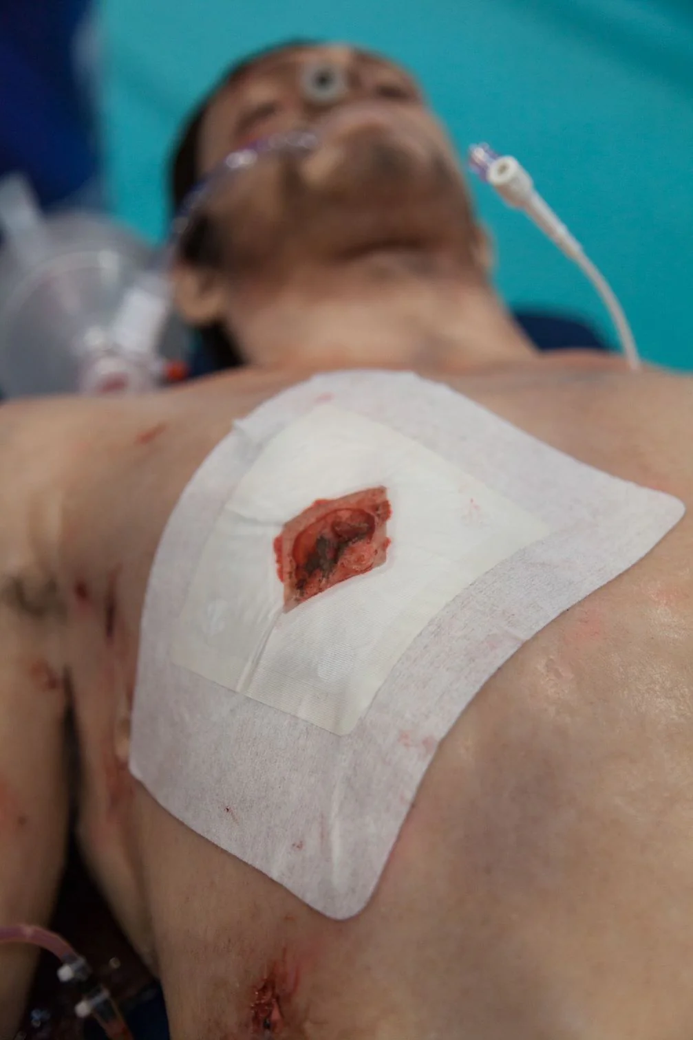 Пов'язка оклюзійна Russell™ Chest Seal