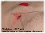 Оклюзійна наліпка HyFin Vent compact twin pack