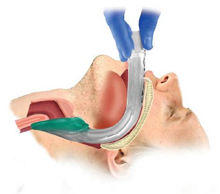 Supralaryngeal airway I-Gel size 4 (50-90kg)