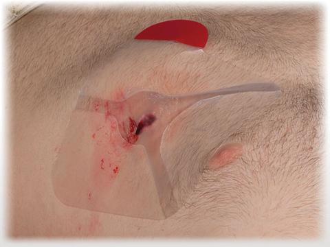 Hyfin Vent Chest Seal Twin Pack