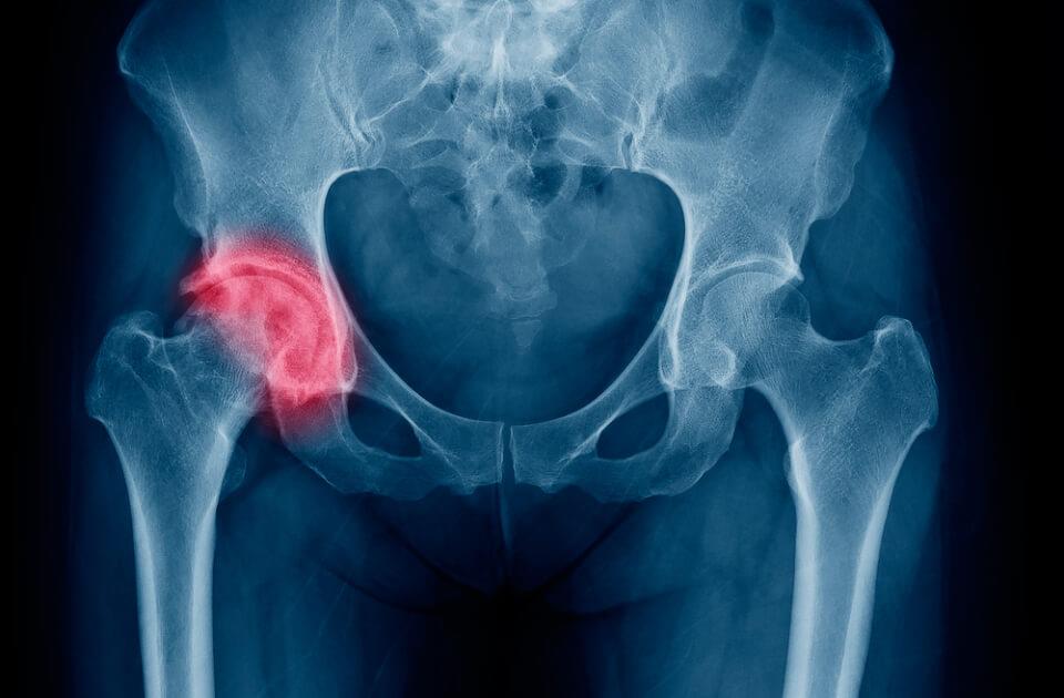 first aid for fractures
