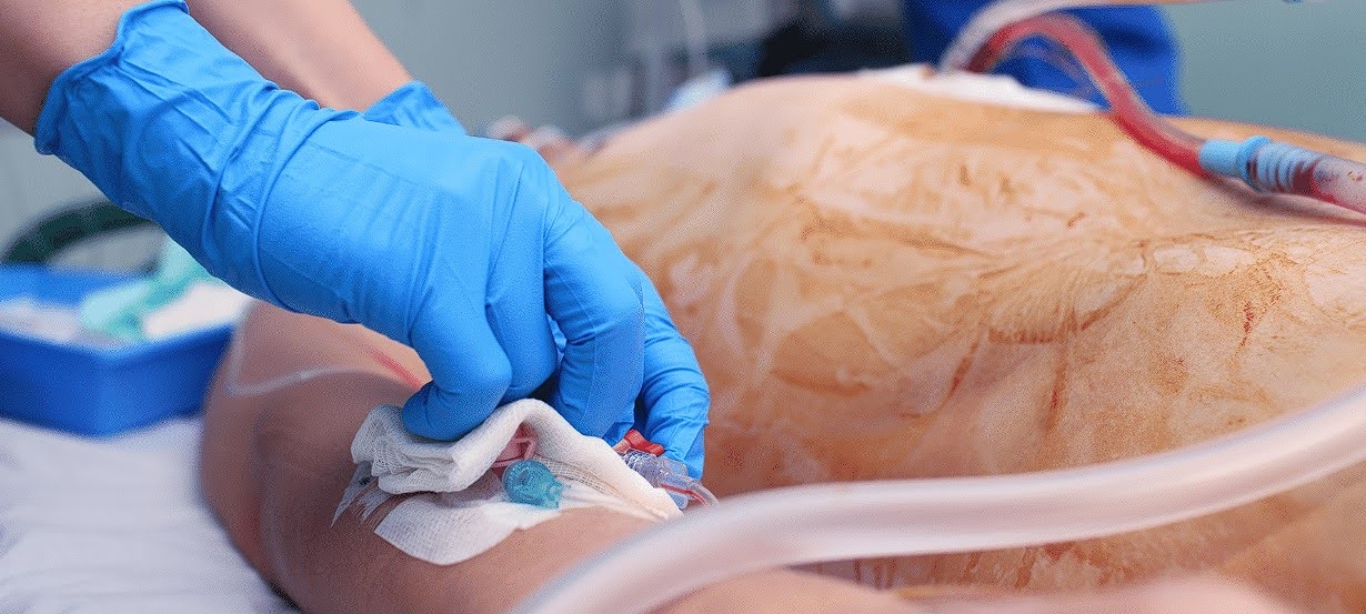 Treatment of chest bruises