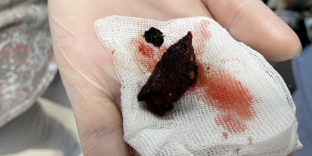 Shrapnel wounds